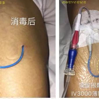 PICC换药步骤、技巧及注意事项最新视频教程